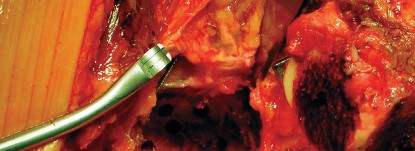 Illustration 60 for Cemented Component Longevity: The Critical Margin of the Acetabulum