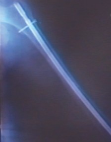 Illustration 22 for Arthrodesis with an Intramedullary Nail: Fixing Failed TKAs