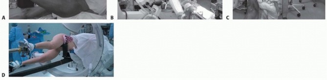 Illustration 12 for Achieve Optimal Femoral Head Fixation with Cephalomedullary Nailing