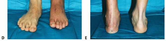Illustration 85 for Mastering Midfoot Arthrodesis: Protect the Deep Neurovascular Bundle