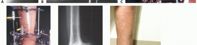 Illustration 28 for Beyond Amputation: Circular Fixation for Infection of the Talus