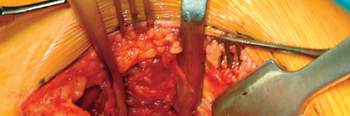 Illustration 49 for Direct Lateral Hip: Optimize Exposure with Sharp Curved Hohmann