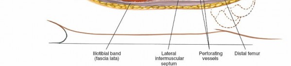 Illustration 21 for Optimal Femoral Approaches: Mastering the Lateral Intermuscular Septum