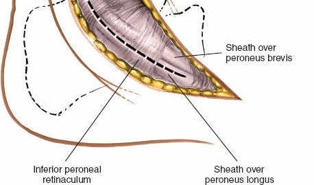 Illustration 5 for Mastering the Lateral Approach to the Posterior Talocalcaneal Joint