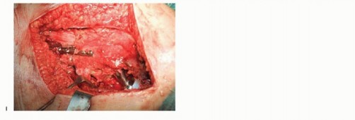 Illustration 35 for Special THA Techniques for Severe Deformities Around the Hip