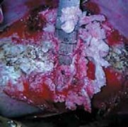 Illustration 19 for Mastering Anterior Interbody Arthrodesis with Instrumentation for Scoliosis