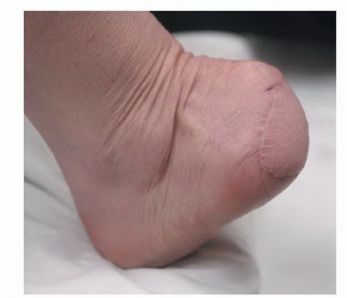 Illustration 3 for Treating Tumors of the Foot: Optimizing Amputation & Resection