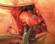 Illustration 25 for Optimal Fixation of the Ankle: Open Reduction & Internal Fixation