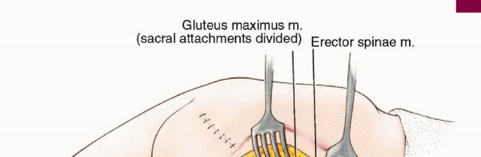 Illustration 9 for Anterior Flap Hemipelvectomy: Leveraging fig tech fig for Difficult Tumors