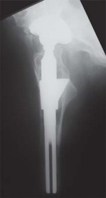 Illustration 63 for S-ROM: Inside the Technique of Modular Implant Design