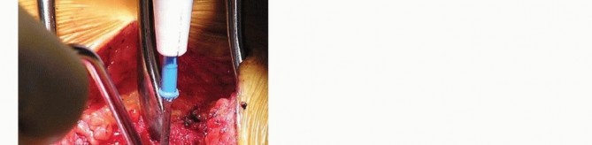 Illustration 13 for Mastering High-Grade Spondylolisthesis: Posterolateral and Interbody Fusion