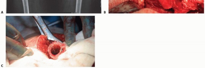 Illustration 13 for Special THA Techniques for Severe Deformities Around the Hip