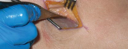 Illustration 11 for Minimally Invasive THA: Navigating Techniques, Benefits & Pitfalls