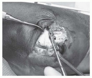 Illustration 2 for Expert Guide to Triple Arthrodesis et al. for Hindfoot