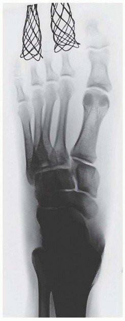 Illustration 10 for Fixation of Lisfranc Injuries: Essential Open Reduction Guide