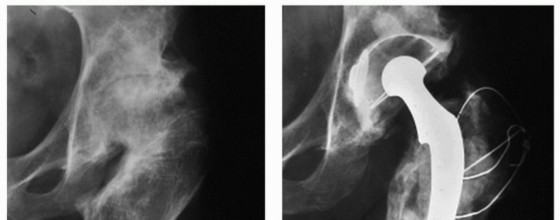 Overcoming Proximal Femoral Deformity in THA: Key Strategies