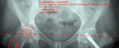Cemented Femoral Stem Figures: Surgical Anatomy & Placement