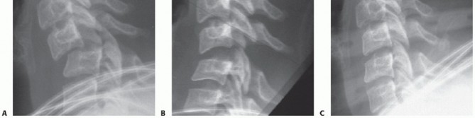 Illustration 32 for Master Techniques for Cervical Fracture Reduction: Type III & More