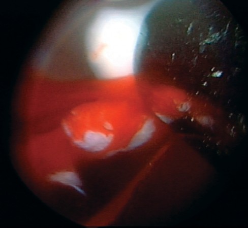 Illustration 20 for Essential Hip Arthroscopy Techniques for Optimal Outcomes