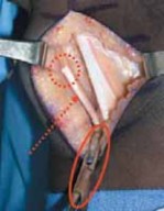 Illustration 17 for Unlocking Mobility: Distal Lengthening for Lateral Hamstring Muscle