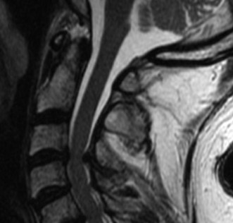 Illustration 7 for Adjacent Segment Degeneration: Your Next Spine Case Solved