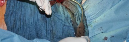 Illustration 32 for Collum Femoris Preserving: Achieve Better Primary Hip Outcomes