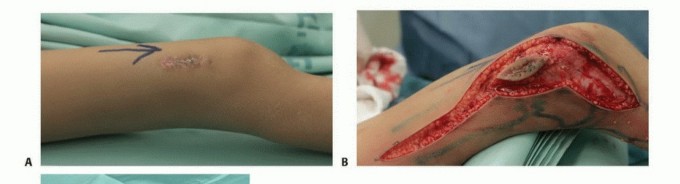 Illustration 31 for Precision Biopsy of Musculoskeletal Tumors for Accurate Diagnosis