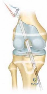 Orthopedic Surgery Board Review MCQs: AAOS Master Bank Part 77