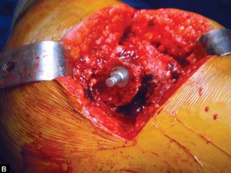 Illustration 48 for The Silent Hip: Achieving a Truly Silent, Pain-Free Joint