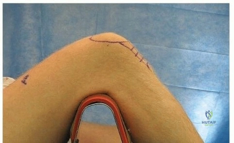 Illustration of q figure a yearold - Dr. Mohammed Hutaif