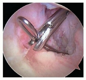 Illustration 13 for Posterior Cruciate Ligament Surgery: Regain Knee Strength & Stability