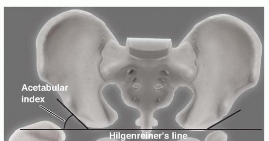 Salter Innominate Osteotomy: Correcting Developmental Hip Dysplasia