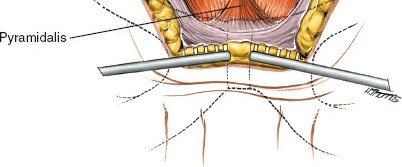 Illustration 18 for Pelvis & Acetabulum Approaches: Unlocking the Posterior Superior Iliac