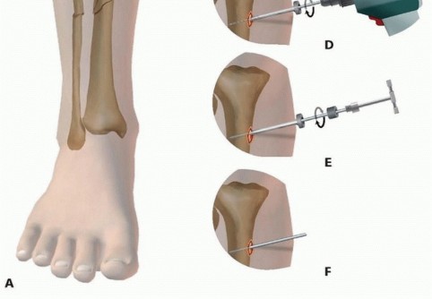 Illustration 24 for Tibia External Fixation: See How Pins Are Placed for Healing