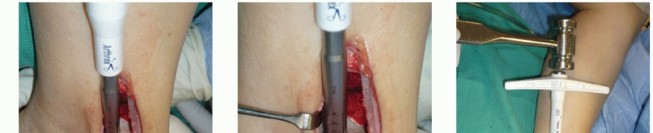 Illustration 16 for Painful Talus Lesions? The tech fig c Osteochondral Transfer Solution