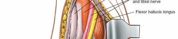 Illustration 24 for Step-by-Step Medial Side of the Ankle Approach Guide