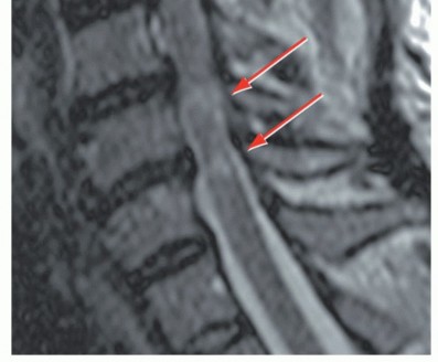 Illustration 5 for Stop Numbness & Instability: Corpectomy and Fusion Guide
