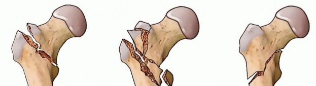 Illustration 3 for ORIF for Peritrochanteric Hip Fractures: Achieve Stable Mobility