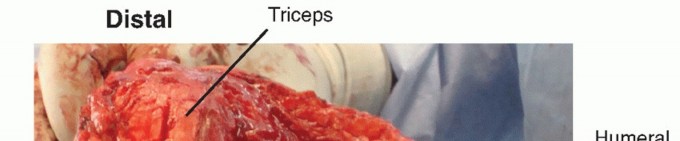 Illustration 16 for Surgical Approaches to Shoulder & Elbow: Pearls and Pitfalls