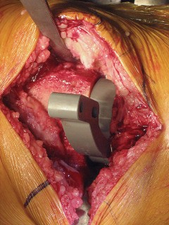 Illustration 39 for Posterior Stabilized Technique: Essential Insights for TKA Success