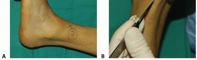 Illustration 2 for Restore Movement: Tendon Transfer for Common Peroneal Nerve Foot Drop