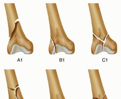 Illustration 18 for Repairing Distal Femur Fractures: Open Reduction & Internal Fixation