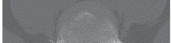 Avoid & Repair: Management of Intraoperative CSF Leaks