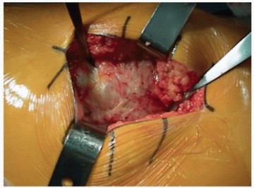 Illustration 2 for Unlock Precision: The Direct Lateral Approach for THA