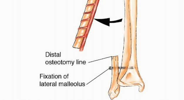 Illustration 5 for Free Vascularized Fibular Grafts: Solving Complex Bone Defects