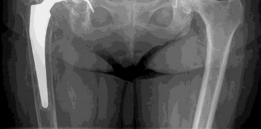Illustration 6 for Revision Hip Success: Unpacking The Case Title Acetabular Grafting