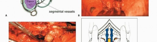 Illustration 20 for Total En Bloc Spondylectomy: Complete Resection for Spinal Tumors