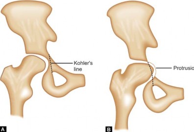Illustration 4 for Total Hip Replacement for Protrusio: Restore Your Hip Function