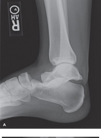 Extensor Digitorum Brevis (EDB) Interposition: A Cause of Blocked Ankle Fracture Reduction
