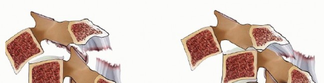 Illustration 29 for Master Techniques for Cervical Fracture Reduction: Type III & More